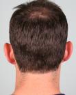 Before Hair Transplant&nbsp;Front